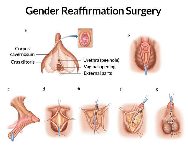 Non binary bottom surgery options